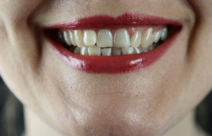 Best ways to fix the gap between your teeth