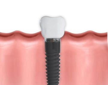 dental implants keller